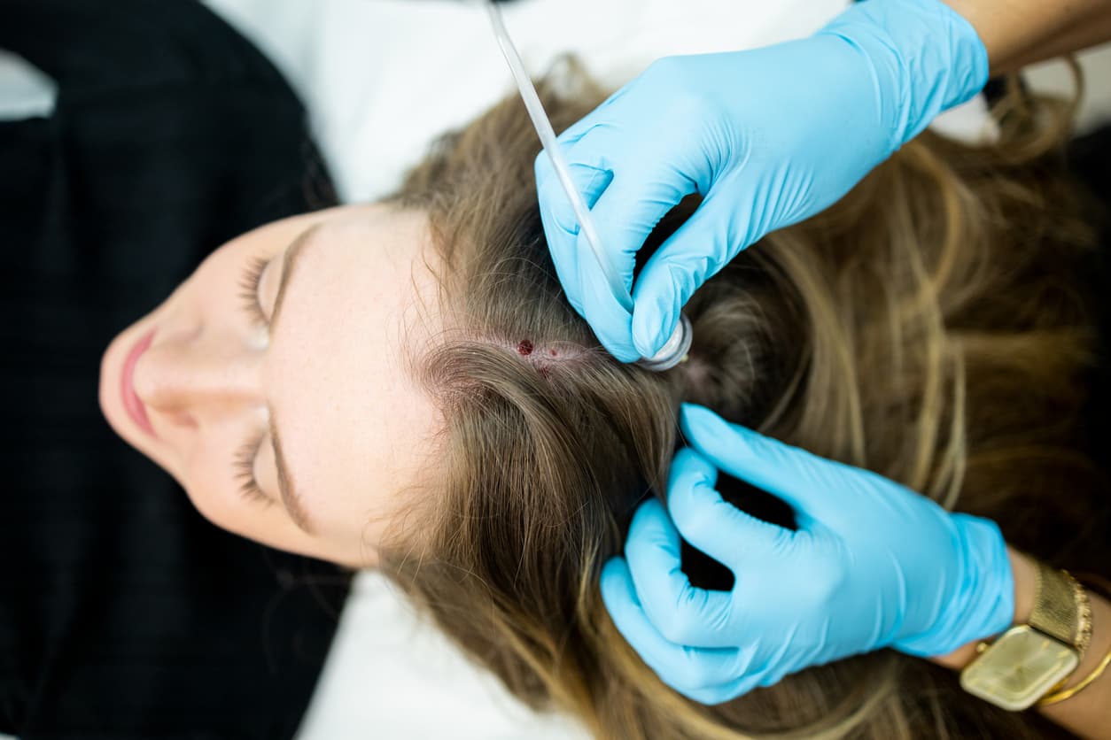Carboxytherapy for Hair Loss in London and Surrey: Does It Really Regrow Hair?