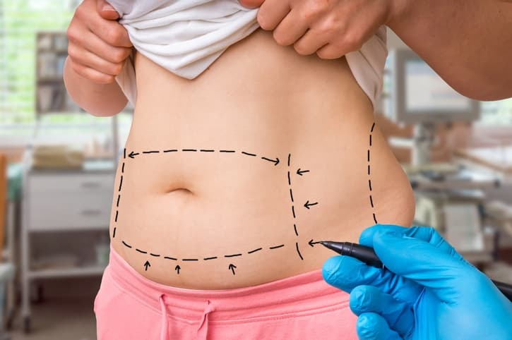 Vaser Liposuction in London – Sculpted Precision by the UK’s Leading Experts