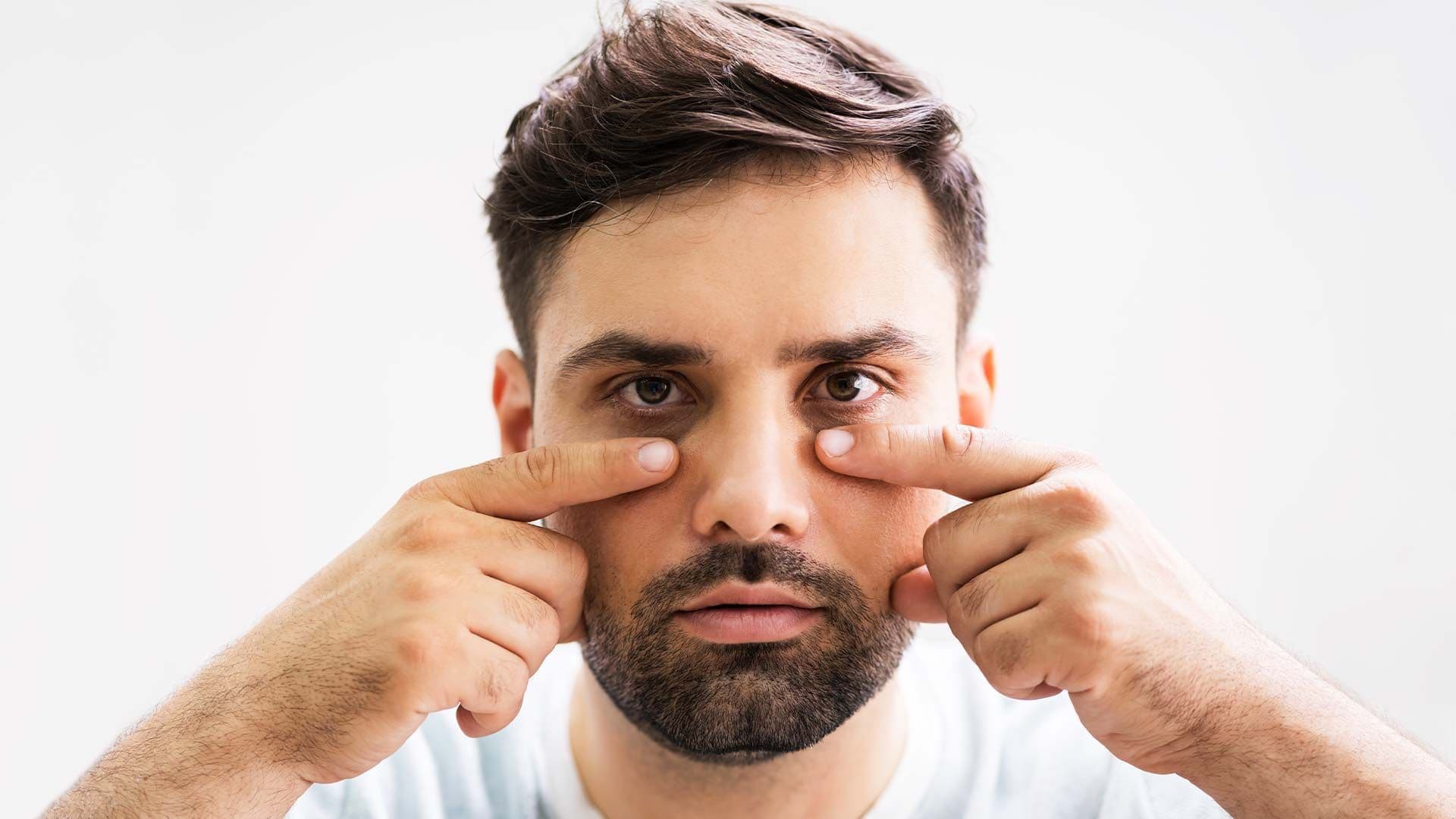 Carboxytherapy for Dark Circles & Baggy Eyes